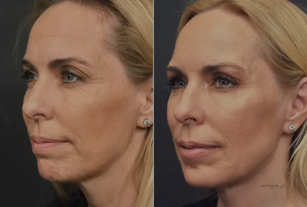 Bioremodeling Skin Booster Profhilo